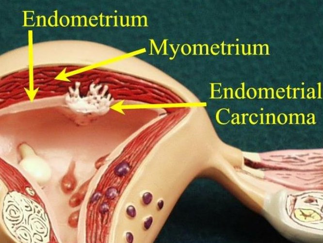 Аденоматоз эндометрия как вылечить thumbnail