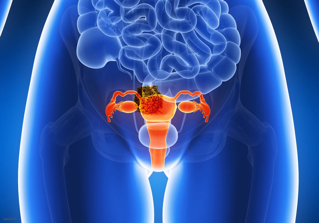 лечение рака тела матки