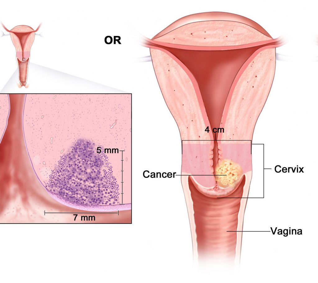 лечение рака шейки матки