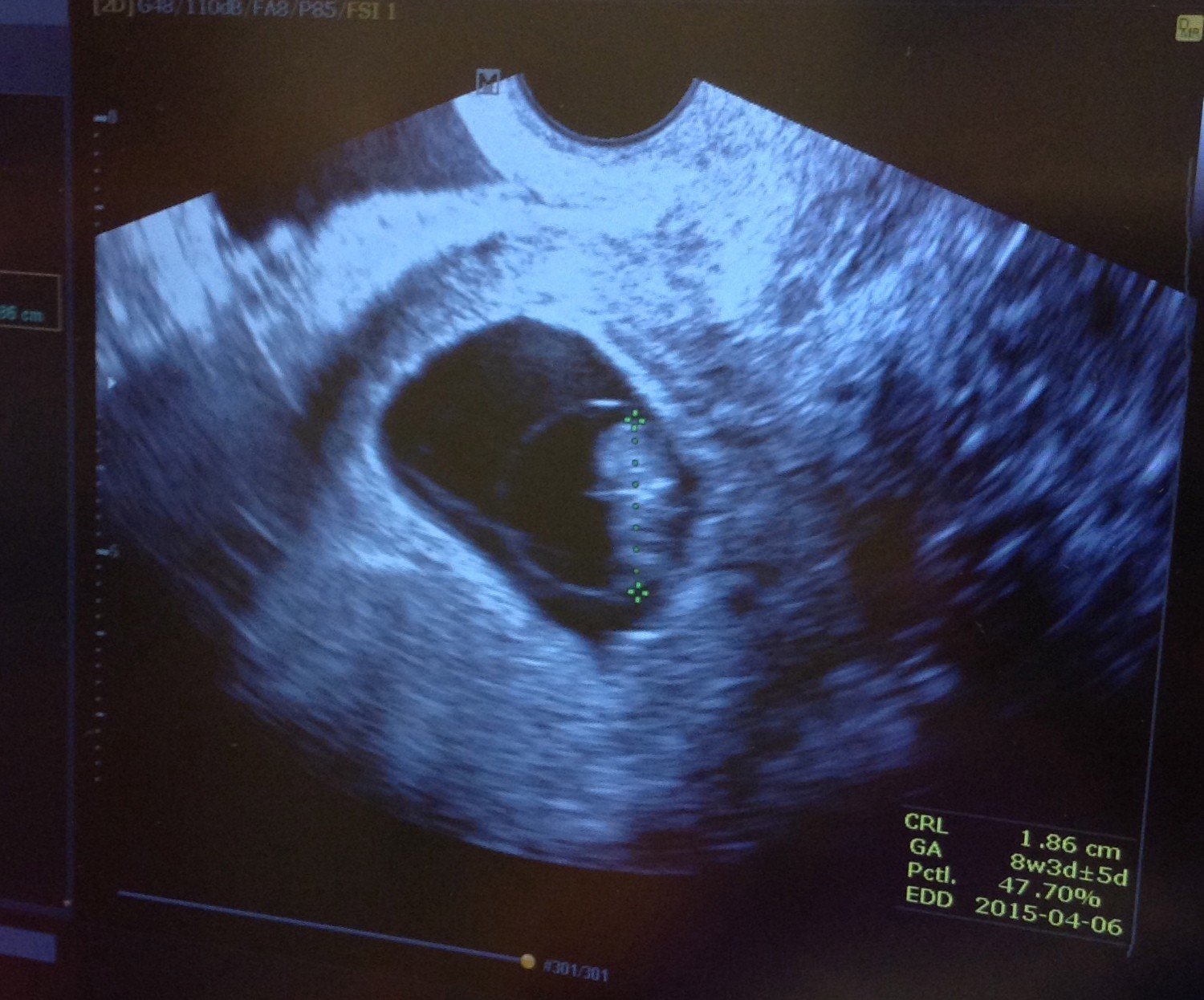 УЗИ анэмбриония 7 недель