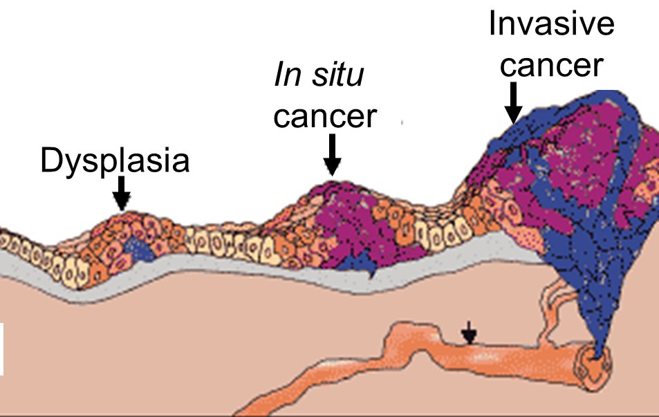 Рак желудка in situ лечение thumbnail
