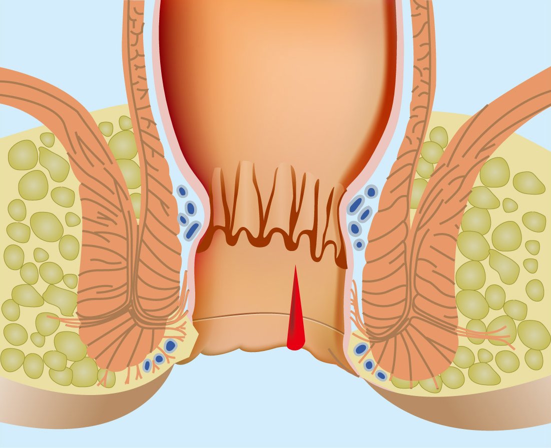 Analoma