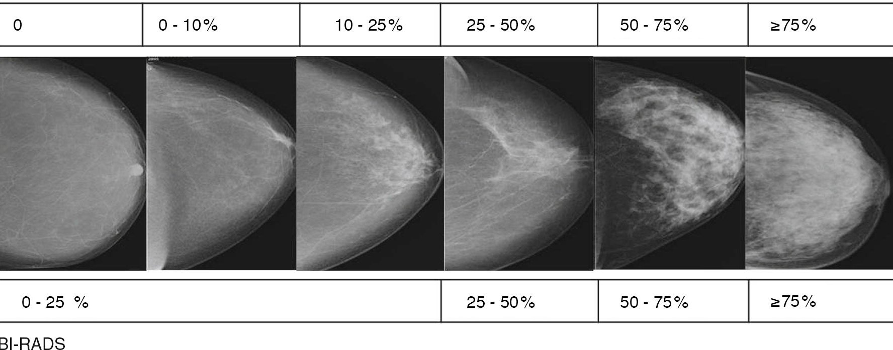 Шкала rads. Маммография молочных желез bi rads 4. Фиброзно кистозная мастопатия молочной железы bi-rads-4a. Маммография классификация bi-rads. Bi-rads 3 молочной железы маммограмма.