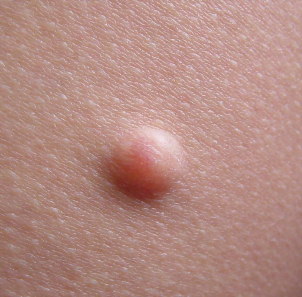 базальноклеточный рак кожи