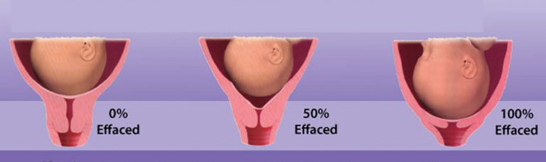ИЦН при беременности: причины, признаки и лечение