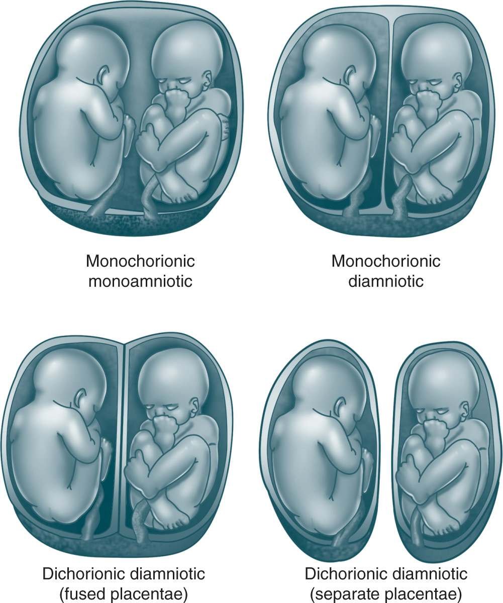 23 недели двойня. Многоплодная беременность разнояйцевые Близнецы. Многоплодная беременность расположение плодов. Многоплодная беременность в утробе. Расположение плодов при многоплодной беременности.