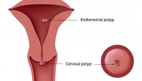 аденоматозный полип эндометрия