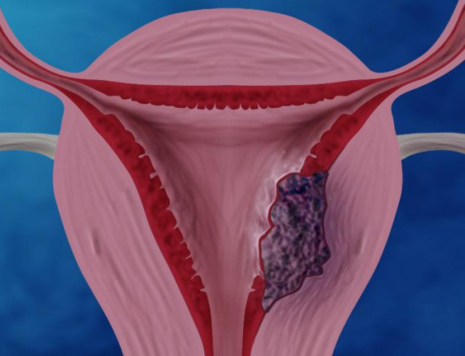симптомы рака матки