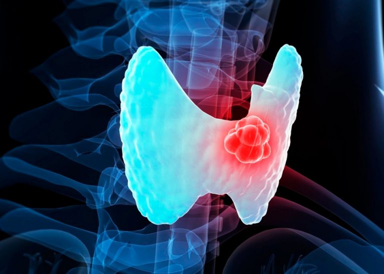 Многоузловой зоб на фоне хронического тиреоидита щитовидной железы