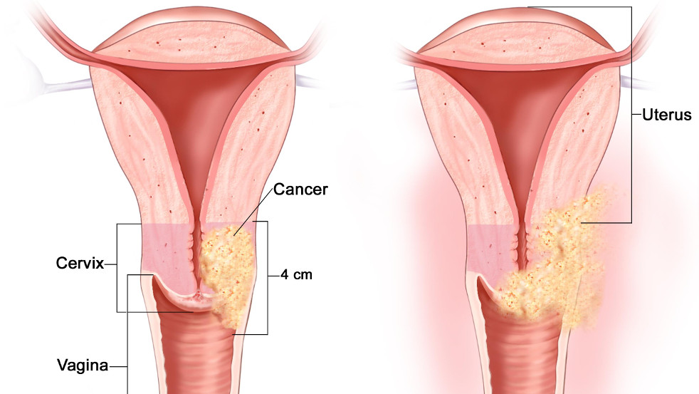 рак шейки матки 2 стадия