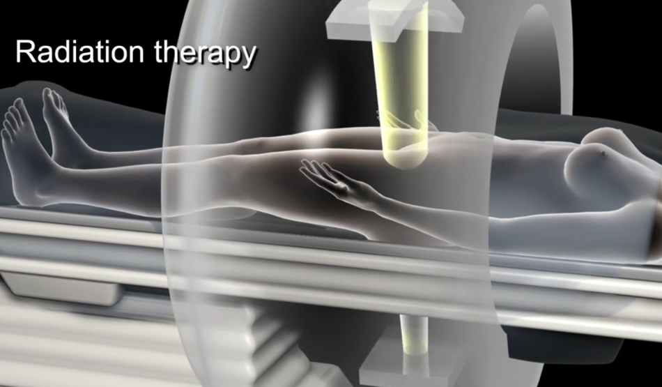 Лазерная деструкция: лучевая терапия при раке шейки матки