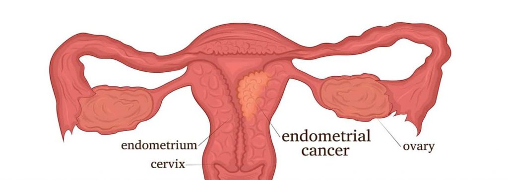 факторы риска рака матки