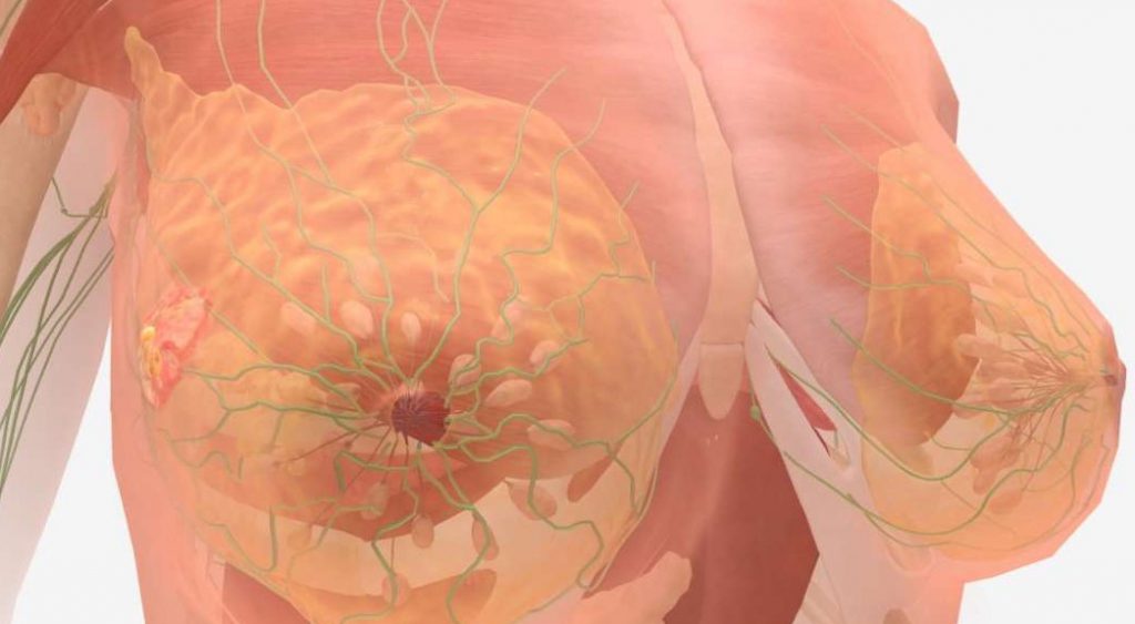 рак молочной железы 4 стадии