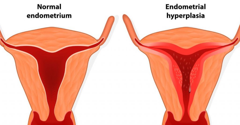 сложная гиперплазия эндометрия