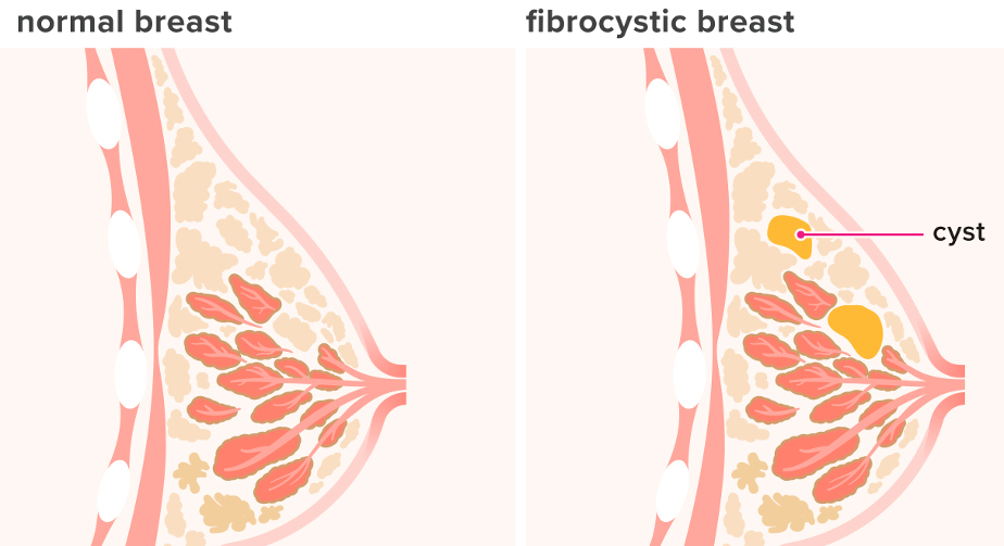 фиброзно-кистозная болезнь молочной железы