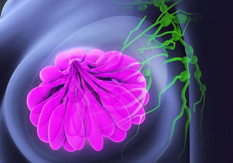 Метастазы при раке молочной железы: пути распространения