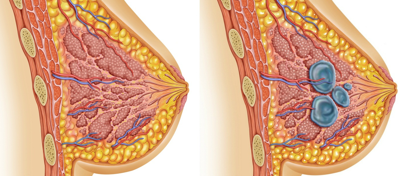 чем опасна мастопатия