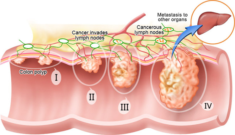 рак прямой кишки 4 стадия