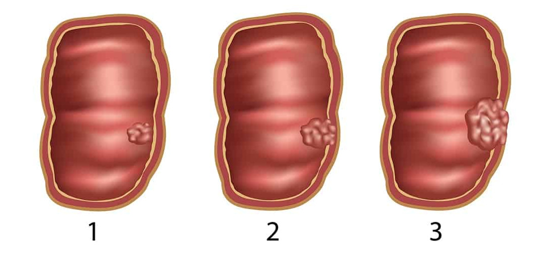рак кишечника 2 стадия