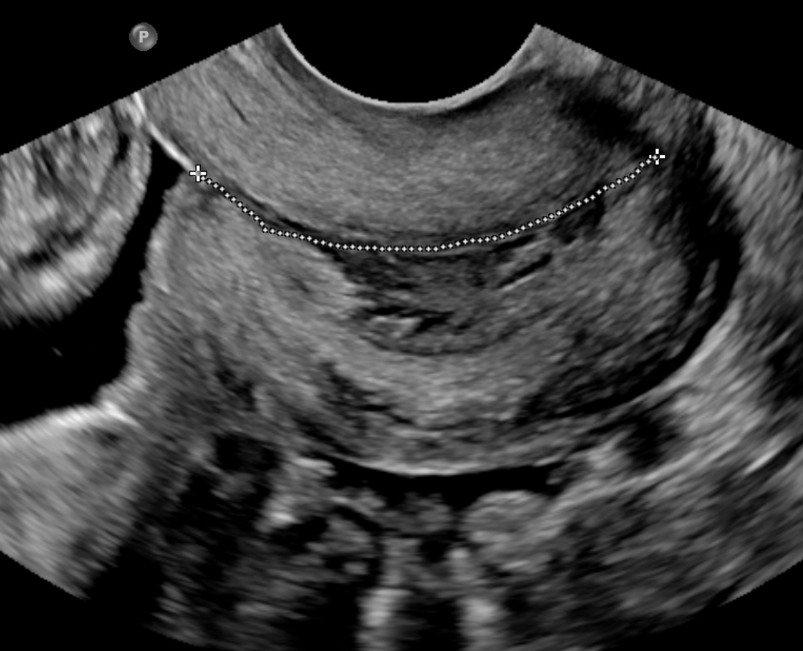 На узи видна шейка матки. УЗИ шейки матки цервикометрия. Шейка матки при беременности УЗИ. Трансвагинальная ультразвуковая цервикометрия. УЗИ цервикометрия при беременности.