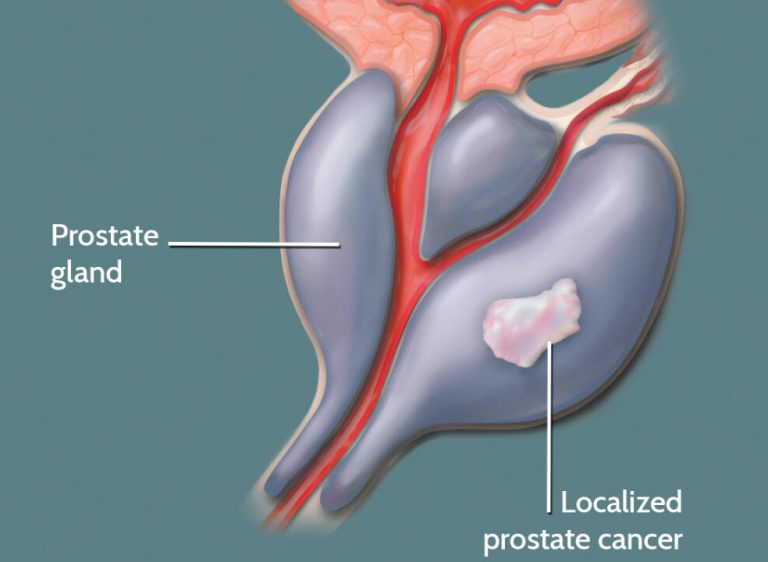 Рак простаты 2 стадии: поставить точный диагноз