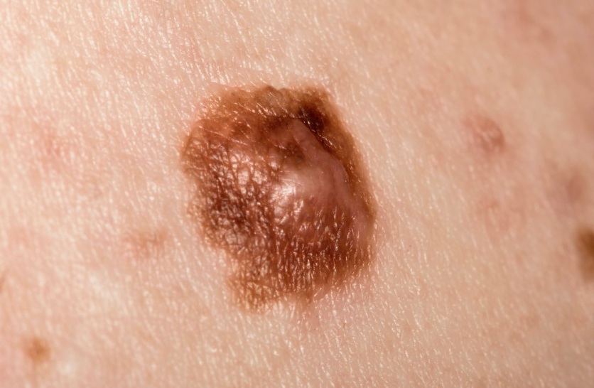 меланома кожи 1 стадии