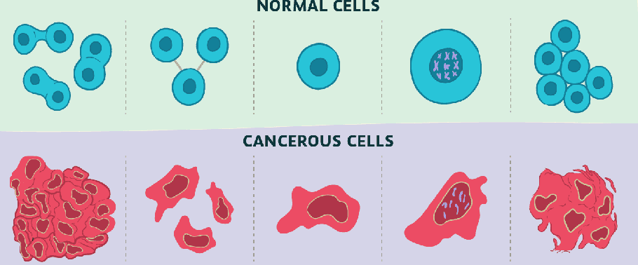 атипия клеток опухоли