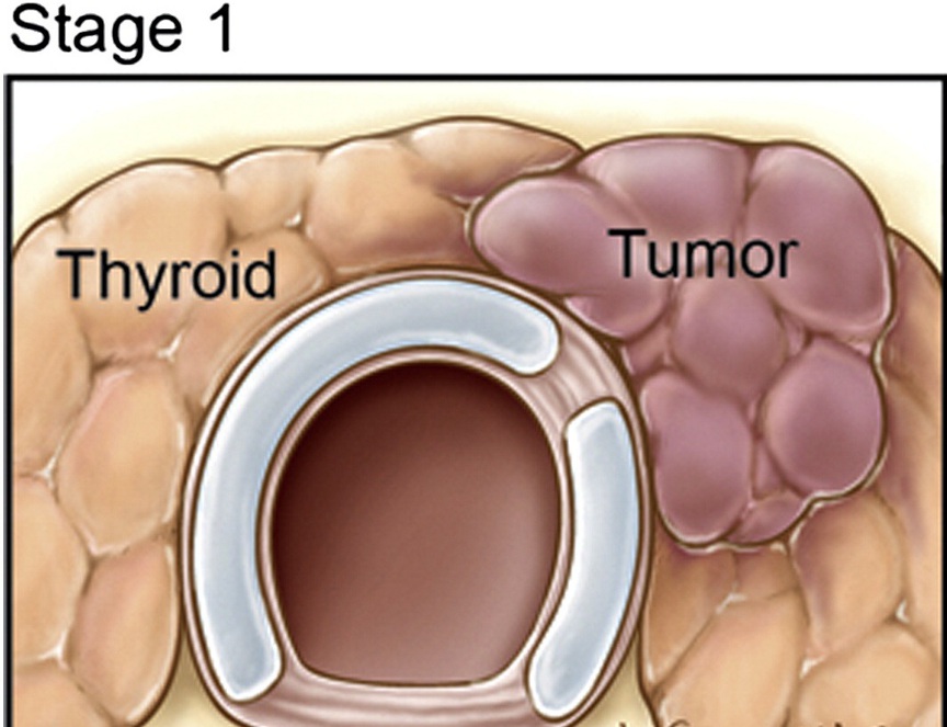 рак щитовидной железы 1 стадии