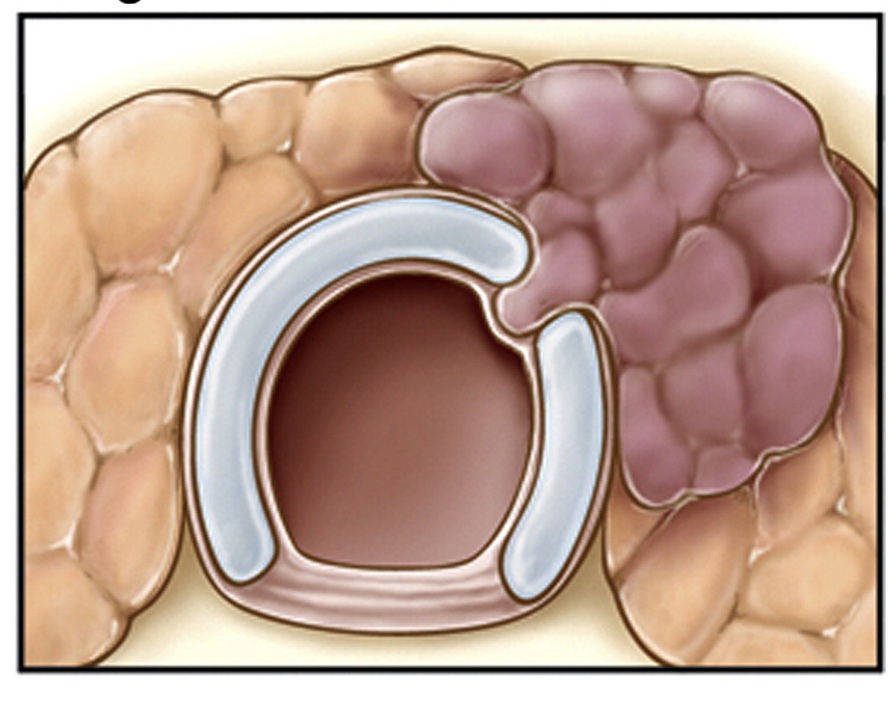 рак щитовидной железы 2 стадии
