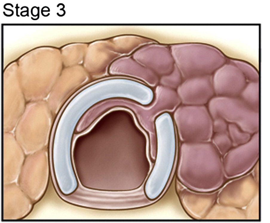 рак щитовидной железы 3 стадии