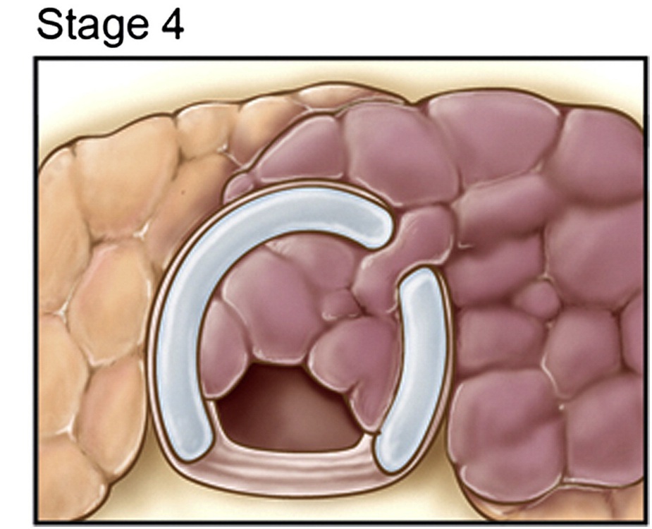 рак щитовидной железы 4 стадии